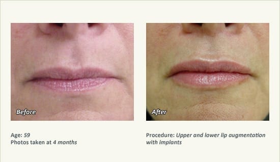 Lip Augmentation in Plano, TX - Patient 23