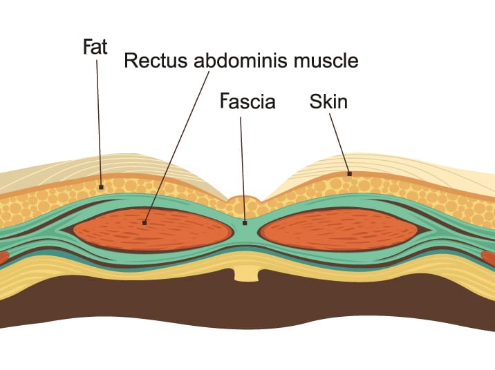 Tummy Tuck Fat Diagram