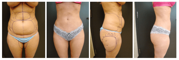 Before & After Liposuction | Ronald M. Friedman, M.D."