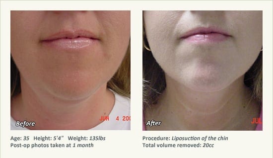 Chin Liposuction in Plano, TX - Patient 48