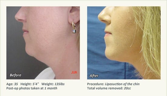 Chin Liposuction in Plano, TX - Patient 49