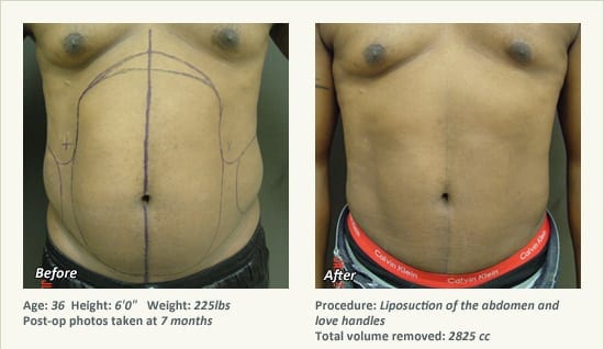 Male Liposuction Surgery - Patient 3