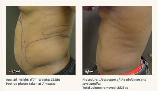 Male Liposuction Surgery - Patient 4