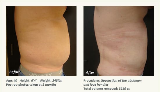 Male Liposuction Surgery - Patient 6