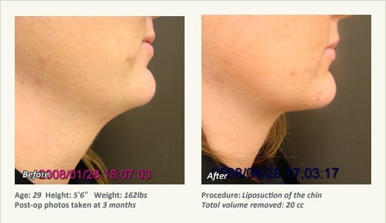 Chin Liposuction in Plano, TX - Patient 81