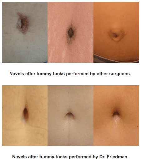 Before & Afte Navel Surgery and Tummy Tuck | Ronald M. Friedman, M.D."