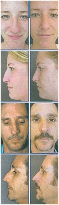 Nasal reshaping results