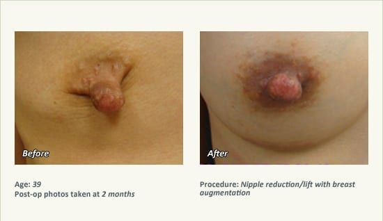 Nipple Procedures (Female) in Plano, TX - Patient 39
