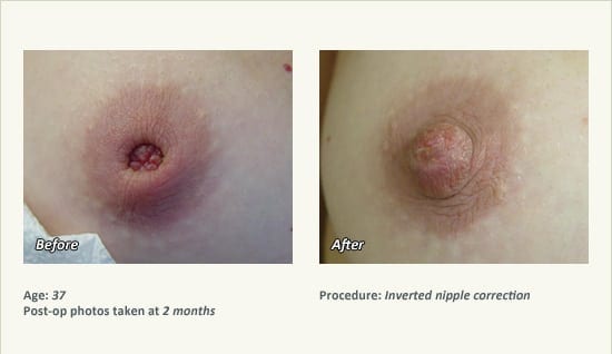 Nipple Procedures (Female) in Plano, TX - Patient 26