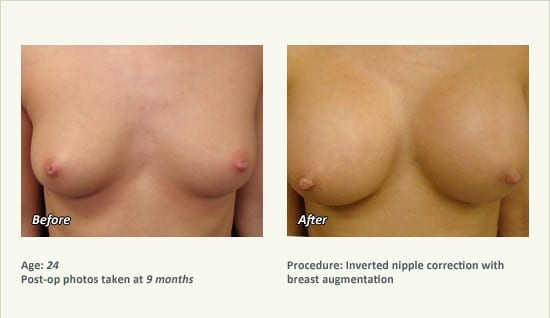 Nipple Procedures (Female) in Plano, TX - Patient 28