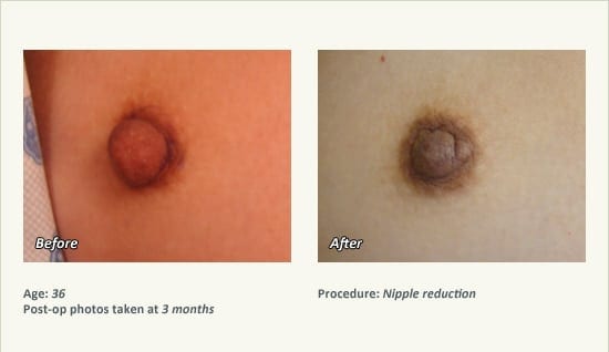 Nipple Procedures (Female) in Plano, TX - Patient 27