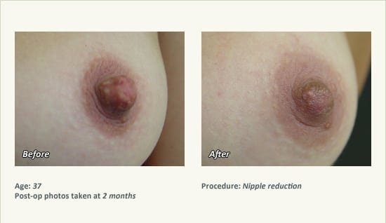 Nipple Procedures (Female) in Plano, TX - Patient 29