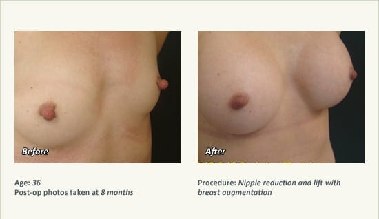 Nipple Procedures (Female) in Plano, TX - Patient 33