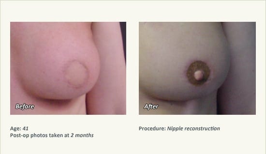 Nipple Procedures (Female) in Plano, TX - Patient 35