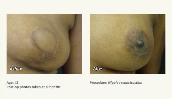 Nipple Procedures (Female) in Plano, TX - Patient 36