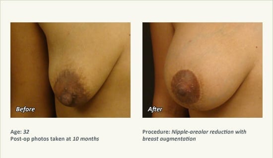 Nipple Procedures (Female) in Plano, TX - Patient 37