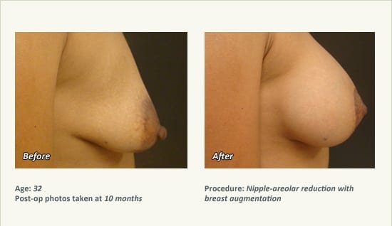 Nipple Procedures (Female) in Plano, TX - Patient 38