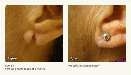 Earlobe Surgery in Plano, TX - Patient 61