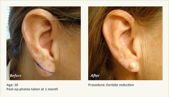 Earlobe Surgery in Plano, TX - Patient 46