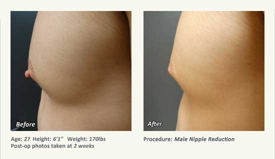 Male Nipple Reduction in Plano, TX - Patient 28