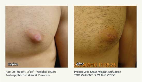 Male Nipple Reduction in Plano, TX - Patient 29