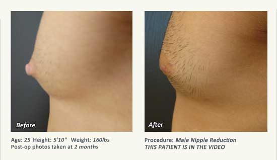 Male Nipple Reduction in Plano, TX - Patient 30