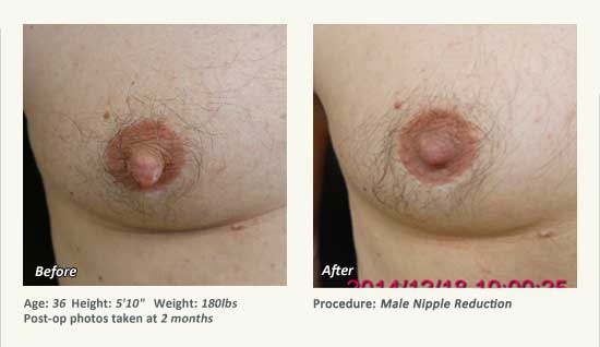 Male Nipple Reduction in Plano, TX - Patient 31