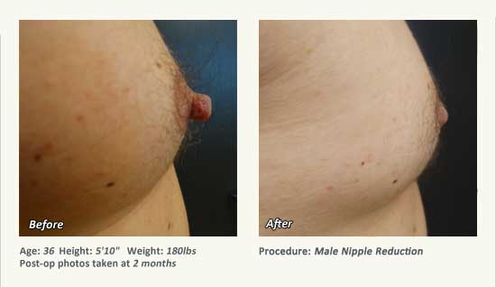 Male Nipple Reduction in Plano, TX - Patient 32