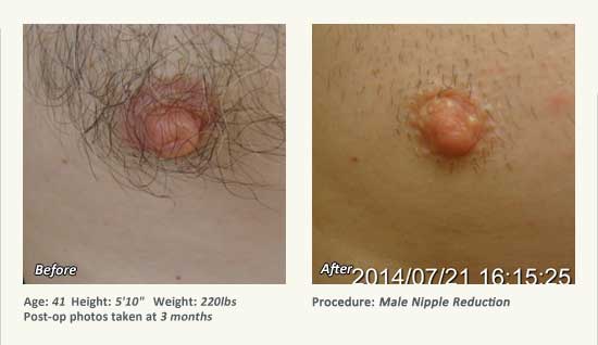 Male Nipple Reduction in Plano, TX - Patient 33