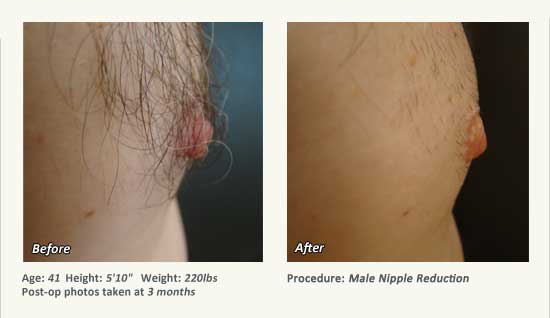 Male Nipple Reduction in Plano, TX - Patient 34