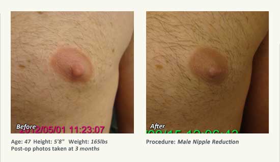 Male Nipple Reduction in Plano, TX - Patient 35