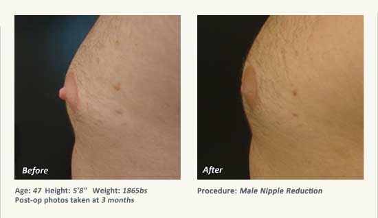 Male Nipple Reduction in Plano, TX - Patient 36