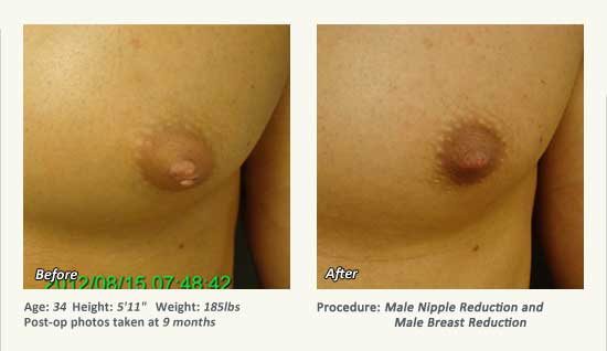 Male Nipple Reduction in Plano, TX - Patient 37