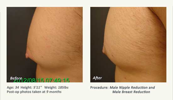 Male Nipple Reduction in Plano, TX - Patient 38