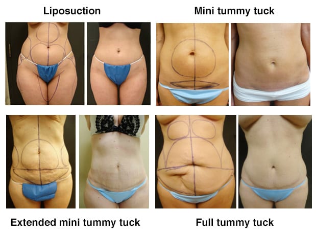 Abdominoplasty fat diagram