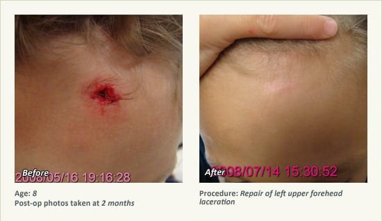 Reconstructive Surgery in Plano, TX - Patient 5