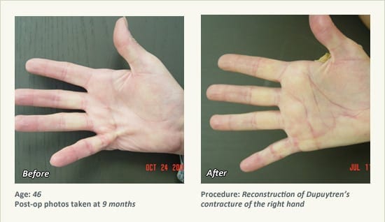 Reconstructive Surgery in Plano, TX - Patient 6