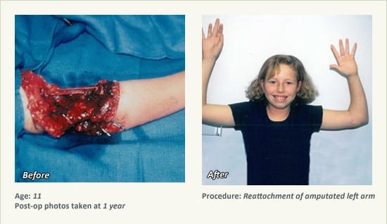 Reconstructive Surgery in Plano, TX - Patient 7