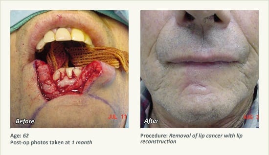 Reconstructive Surgery in Plano, TX - Patient 8