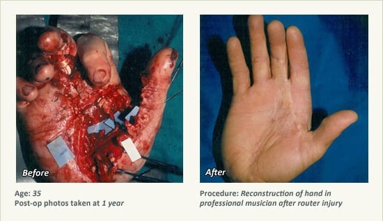 Reconstructive Surgery in Plano, TX - Patient 9
