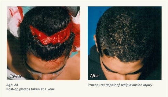 Reconstructive Surgery in Plano, TX - Patient 11