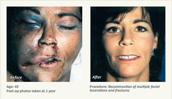 Reconstructive Surgery in Plano, TX - Patient 12