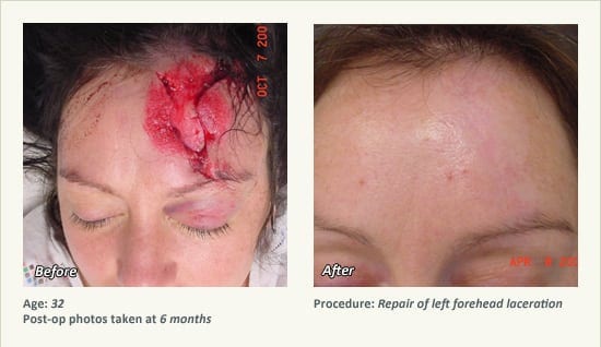 Reconstructive Surgery in Plano, TX - Patient 13