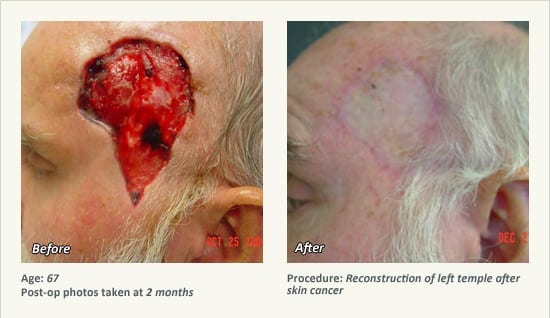 Reconstructive Surgery in Plano, TX - Patient 15