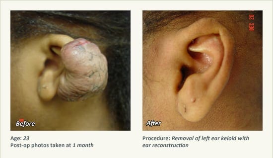 Reconstructive Surgery in Plano, TX - Patient 14