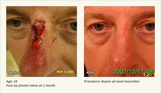 Reconstructive Surgery in Plano, TX - Patient 16