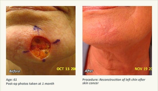 Reconstructive Surgery in Plano, TX - Patient 17