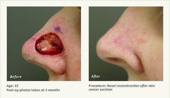 Reconstructive Surgery in Plano, TX - Patient 18