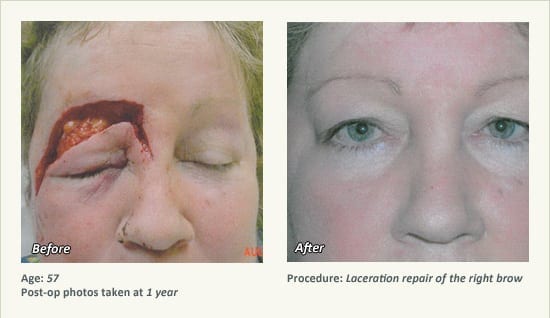 Reconstructive Surgery in Plano, TX - Patient 19