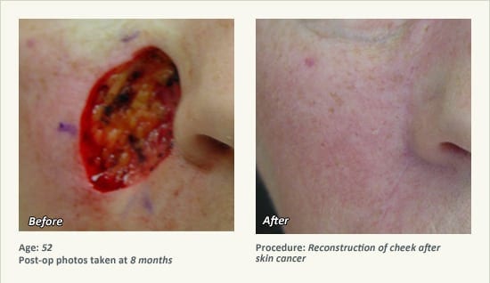 Reconstructive Surgery in Plano, TX - Patient 20